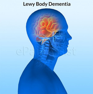 dementia with lewy bodies brain