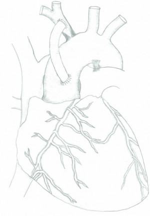 Innominate Artery Bypass