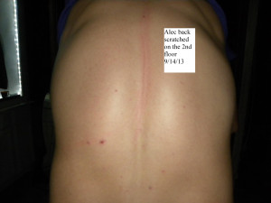 Back Scratch Marks Then the biggest scratch