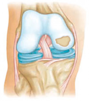 Articular Cartilage Repair