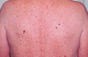 Atypical Mole Dysplastic Nevus Workup Medscape Reference