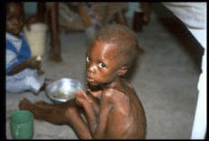 Cliniquement, la malnutrition est caractérisée par une prise ...