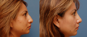 Get YOUR INSTANT Online Rhinoplasty Quote NOW! Click Here...