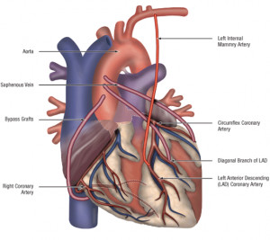 Coronary Artery Bypass Grafting (CABG)