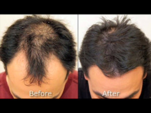 Neograft Automated Fue Hair
