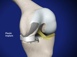 Partial Knee Replacement (Using Oxford Implant)