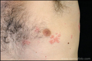 Description Herpes Zoster...