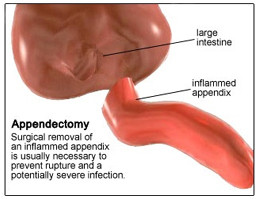 Cost Appendectomy Surgery, India Surgery Appendix Appendectomy Surgery ...