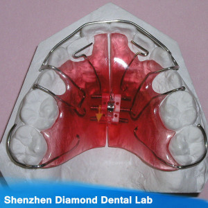 Orthodontic Lingual Retainer