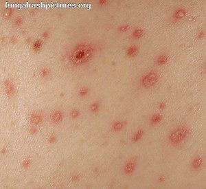 Baby Fungal Rash Pictures