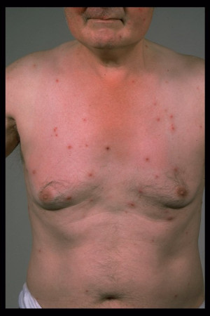 Related to What Is Disseminated Herpes Zoster With Pictures