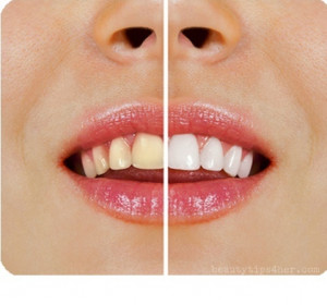 What you will need to whiten your teeth :