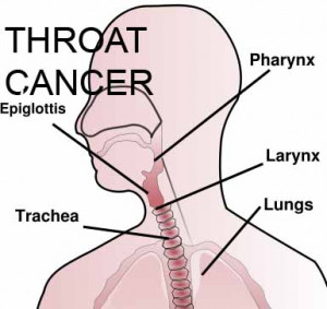 throat cancer Images and Graphics