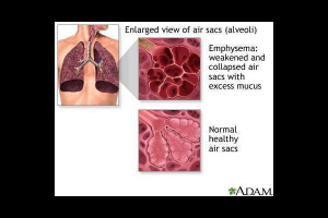 Image of Chronic obstructive pulmonary disease