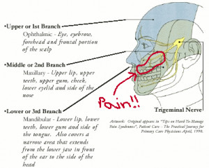 About 'Trigeminal neuralgia'