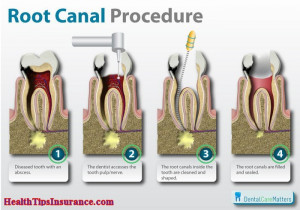 Root Canal By National Institutes Of Health