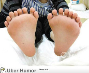 Polydactyly: this little boy had 31 fingers and toes.
