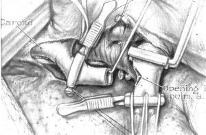 An illustration by Leon Schlossberg of the procedure.