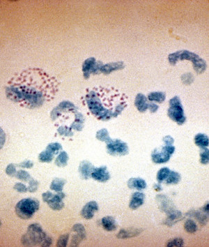 gonorrhea and syphilis rose for the second year in a row in the u