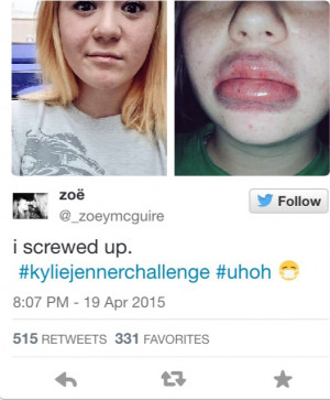 Kylie Jenner Challenge is Taking Over the Net & It’s GROSS! (VIDEO)