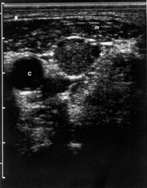 Abnormal Thyroid Ultrasound Lymph Nodes