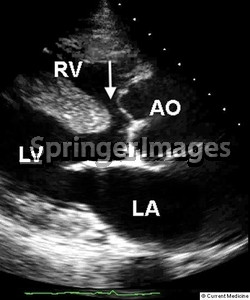 Tetralogy of Fallot Overriding Aorta