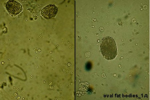 oval fat bodies in urine sediment
