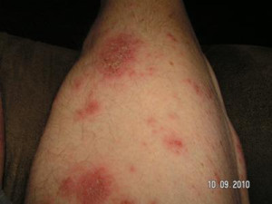 does exposure to chickenpox cause shingles