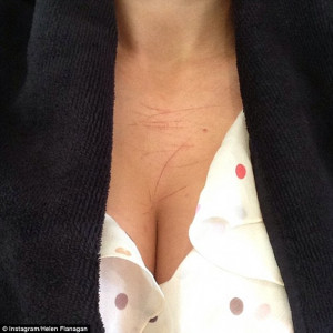 Scratches: Helen Flanagan shared an image of her scratched chest on ...