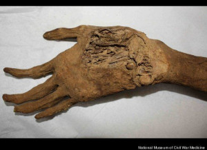 Severed Arm from the American Civil War is on Display in Maryland