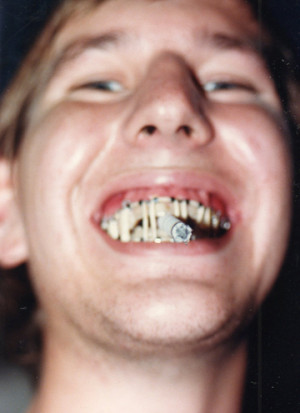 Broken Jaw Wired Shut Eat Detail: murphy's jaw wired