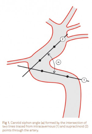Posterior Internal Communicating Carotid Artery