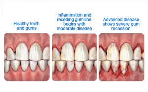 Pictures of Gums for Comparison