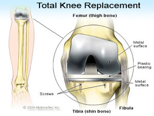 Picture of a total knee replacement