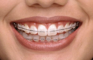 braces we have braces to suit every patient from funky colours to ...