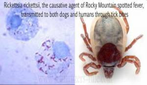 Rocky Mountain Spotted Fever Tick Bite Rocky mountain spotted fever