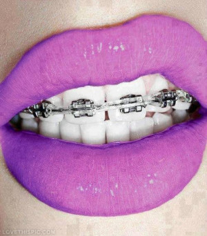 Braces Colors Tumblr Purple lips and braces