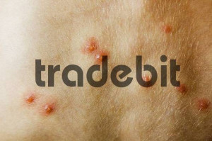 child with chickenpox varicella zoster infection