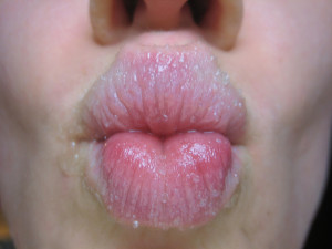 Crusty Lips