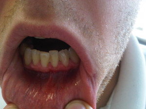 Thread: Do I have gum disease?