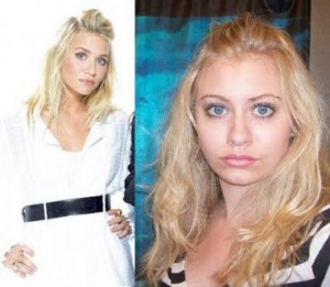 Olsen twins plastic surgery