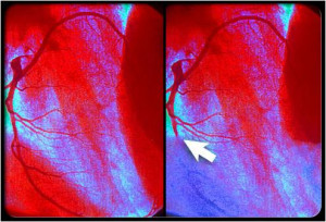 of coronary artery disease a precursor to a heart attack coronary ...