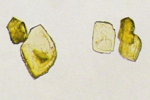 uric acid crystals in urine sediment