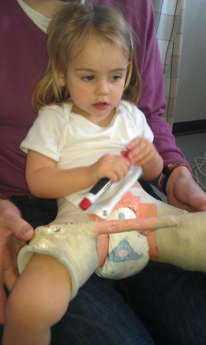 Cast For Hip Dysplasia With Baby