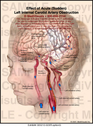 internal carotid artery segments