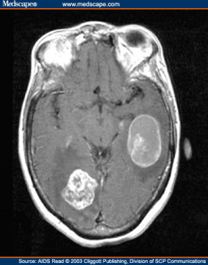 What Does a Lesion On Brain MRI Look Like