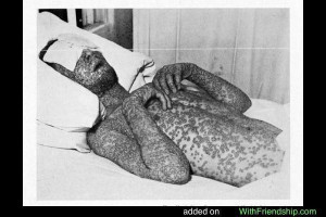 Smallpox victim