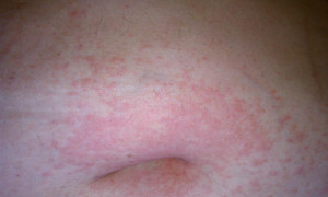 Itchy Rash On Belly