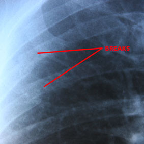 post fight x-ray shows silva had cracked rib.