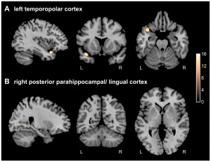 dissociative identity disorder brain scan